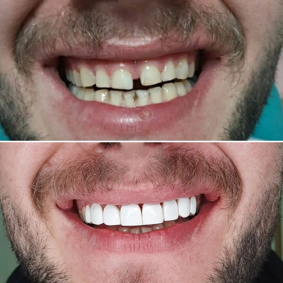 نمونه کار دندان 4